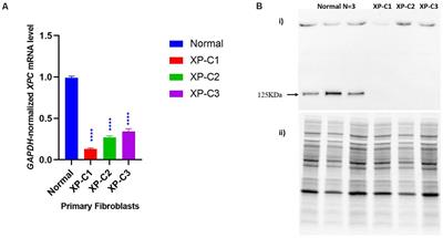 <mark class="highlighted">Xeroderma</mark> Pigmentosum C (XPC) Mutations in Primary Fibroblasts Impair Base Excision Repair Pathway and Increase Oxidative DNA Damage